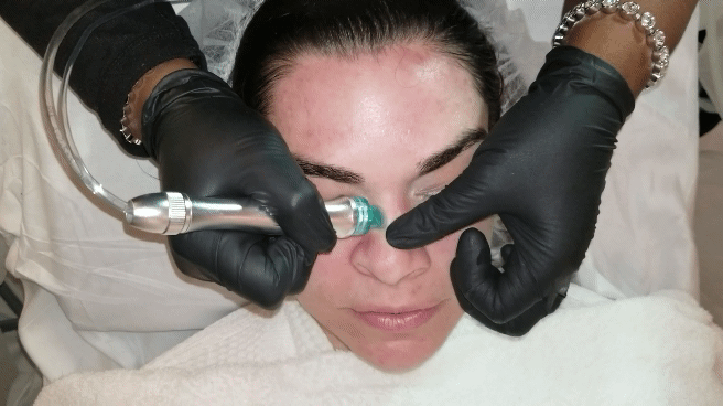 hydradermabrasion